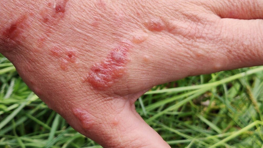Giant Hogweed Blisters